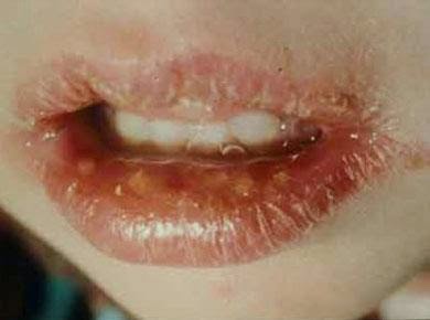 Poner alcohol en el herpes labial